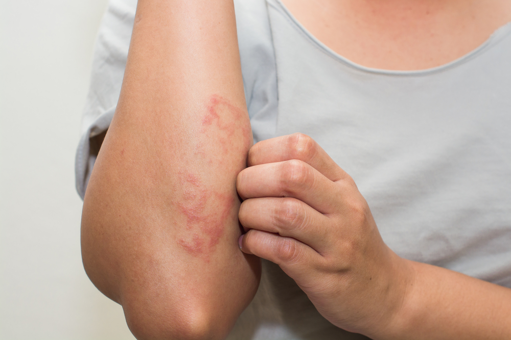 How to Use CBD Oil Effectively For Eczema